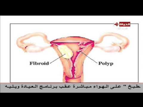 شاهد مراحل النزيف المهبلي حتى الأورام السرطانية