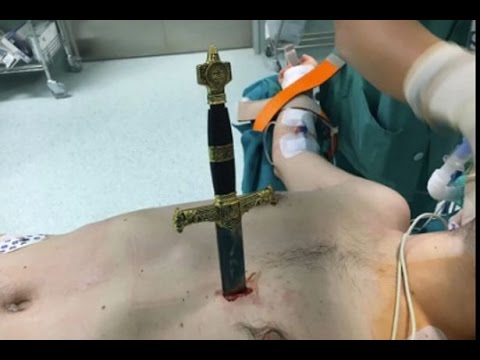 لقطات مذهلة لجراح يزيل سيفا من صدر رجل