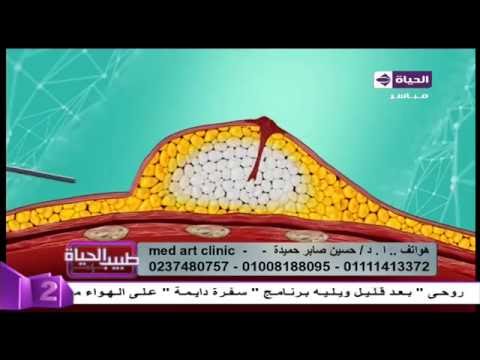 بالفيديو فيديو يكشف عمليات تكبير الثدي بحقن الدهون