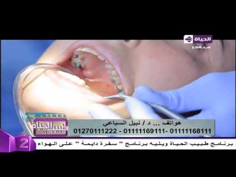 بالفيديو خطوات إجراء عملية زراعة الأسنان على أحد المرضى