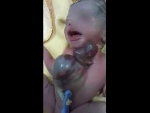 فيديو مستشفى أبو الريش يستقبل حالة طبية نادرة