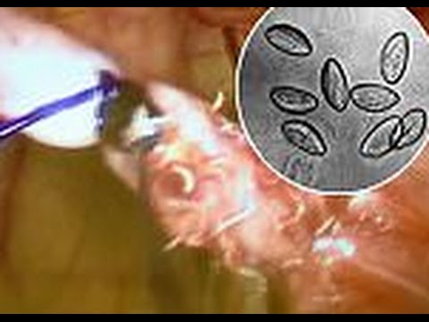 شاهد الأطباء يعثرون على كتلة كائنات حية تعيش داخل جسد مراهقة