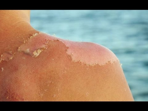 بالفيديو  نصائح هامة لحماية البشرة في فصل الصيف 