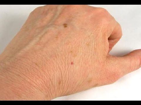 بالفيديو دراسات تكشف كيفية الوقاية من البقع الصبغية