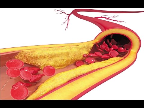 شاهد الجلوس لفترة طويلة يؤدي إلى تصلّب الشرايين