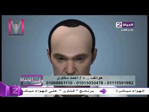 بالفيديو  تعرف على تفاصيل عملية زراعة الشعر