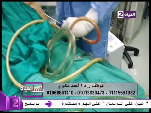 بالفيديو كيف تتم عملية شفط الدهون