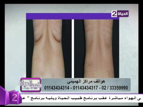 بالفيديو شاهد نتائج شفط الدهون