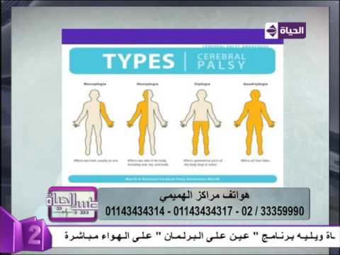بالفيديو أشكال و أنواع الإصابة المخية  cp