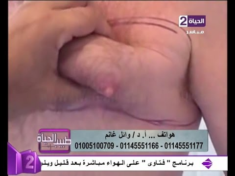 علاج ترهل الثدي عند الرجال