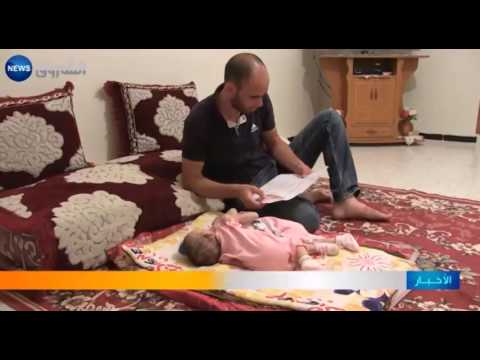 بالفيديو ريان وجهاد توأم بكبد واحد وغشاء قلب واحد