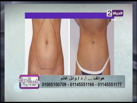 بالفيديو استشاري تجميل يُظهرنتائجًا مبهرة بعد شفط الدهون بالفيزر