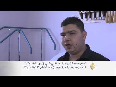 زرع طرف سفلي لشاب أردني بتقنية حديثة