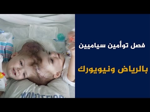 شاهد فصل توأمين سياميين في الرياض ونيويورك
