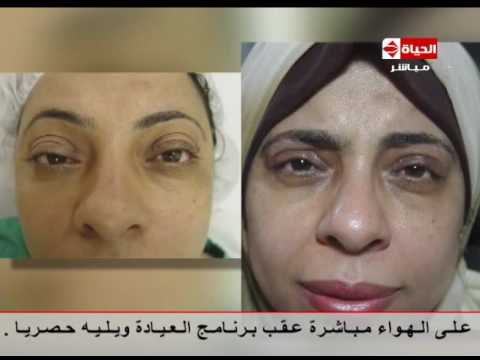 بالفيديو  مدى تأثير نشاط الغدة الدرقية على جفن العين