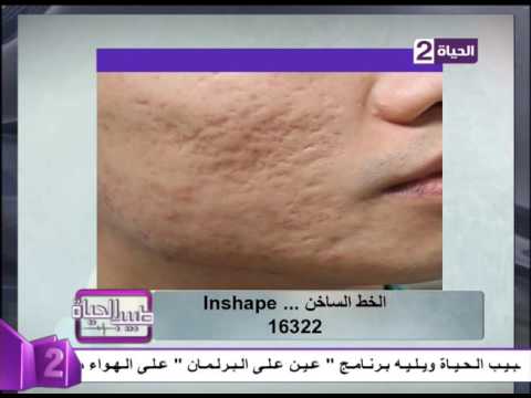 شاهد الدكتور يحيى حشيش يوضح أهمية استخدام الليزر