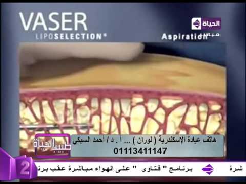 بالفيديو تفاصيل عملية شفط الدهون بالفيزر