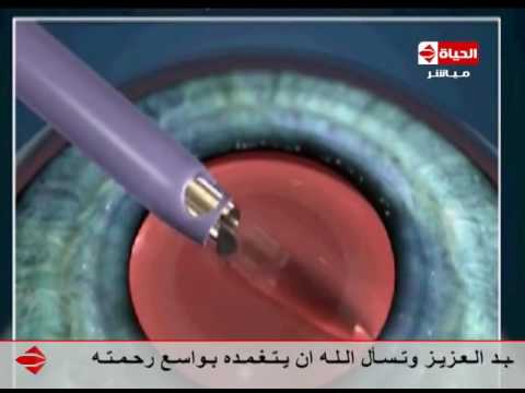 بالفيديو الدكتور ايهاب سعد يوضّح كيفية التخلص من عتامة القرنية