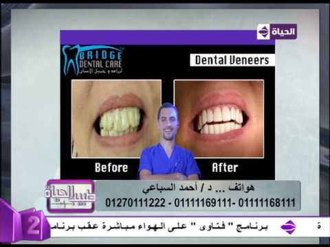 شاهد نتائج مُبهرة بعد تجميل الأسنان