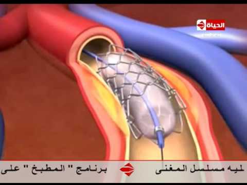 شاهد فيديو يوضّح كيفية عمل الدعامة التعويضية في القلب