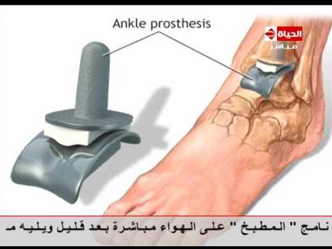 شاهد كيف يتم تغيير المفاصل