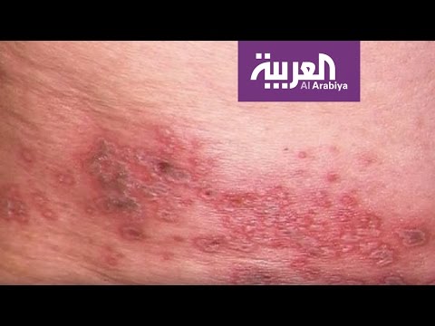 شاهد أعراض مرض الحزام الناري