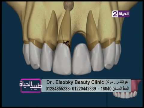الفرق بين التركيبات الثابته وزراعة الأسنان