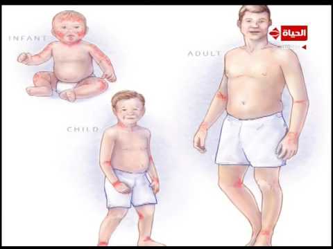 بالصور توضح أنواع الحساسية عند الأطفال