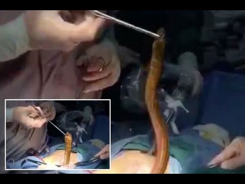 شاهد إخراج ثعبان حي طوله نصف متر من بطن مريض