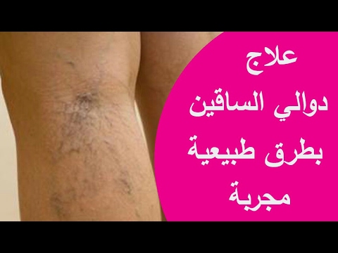 بالفيديو  وصفة طبيعية لعلاج دوالي الساقين خلال 10 أيام