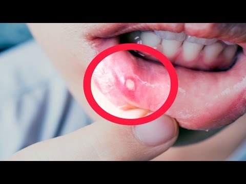 شاهد معالجة علاجات تقرّحات الفم بطرق سليمة ومضمونة