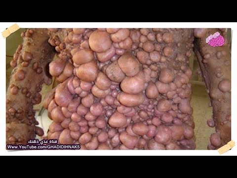 شاهد أكثر 10 أمراض فتاكة في العالم يجب الحذر منها