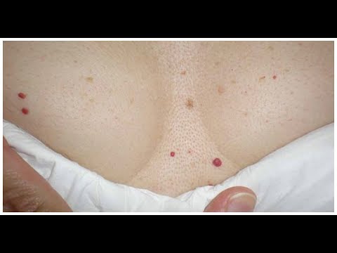 أسباب ظهور البقع الحمراء الصغيرة على