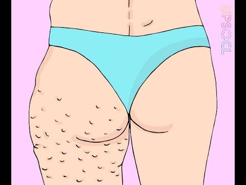 أسباب وطريقة علاج مرض السيلوليت الجلدي