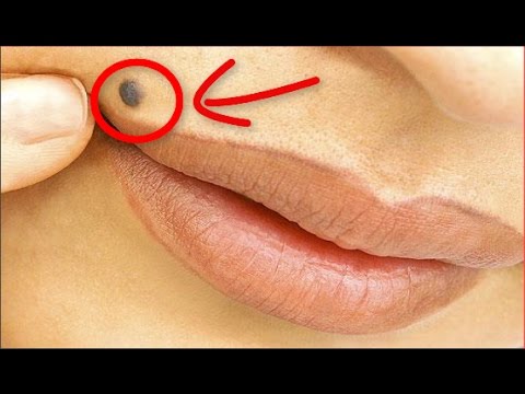 شاهد أسباب وجود الشامات على جسم الإنسان ومدى خطرها على الصحة