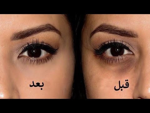 شاهد ما دلالة السواد أسفل العينين وإلى ماذا يُشير