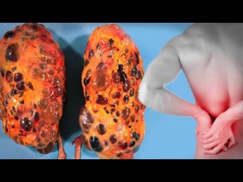 شاهد 8 عادات سيئة تُسبّب الضرر الخطير لكليتيك