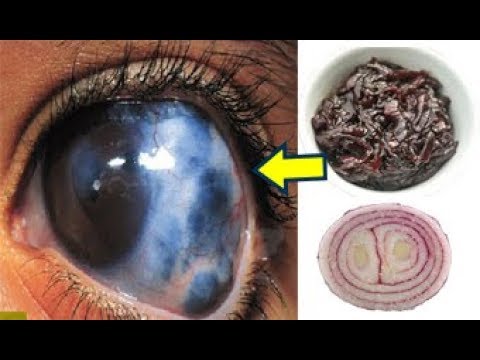 شاهد حبة مذهلة لعلاج ضعف النظر نهائيًا وتحسن البصر