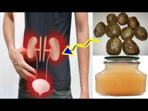 شاهد التخلّص مِن حصى الكلى وآلامها نهائيًّا