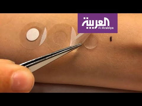 شاهد لصقة طبية تشخّص سرطان الجلد خلال دقائق
