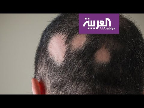 تعرّف على أسباب وأعراض الثعلبة وعلاجاتها