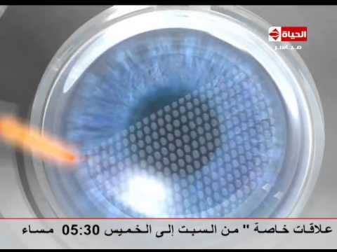 فيديو عملية الفيمتو ليزك وتأثيرها على الصيام