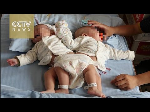 فصل توأم ملتصق باستخدام تكنولوجيا “3d”