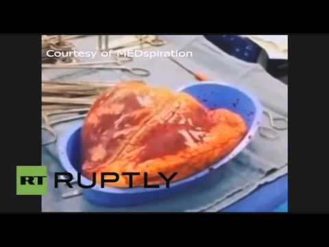 فيديو المواد المخدرة تحافظ على نبض قلب مريض لمدة نصف ساعة