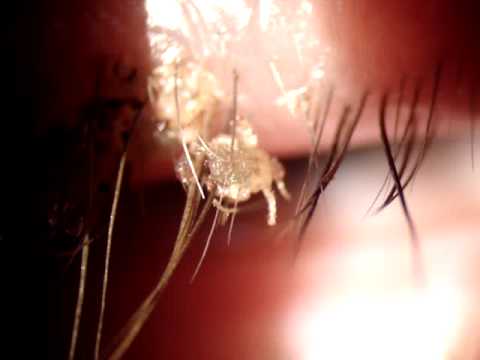 فيديو عائلة من القمل تعيش أسفل رموش امرأة بريطانية