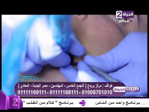 بالفيديو خطوات عملية تركيب ضرس للإنسان