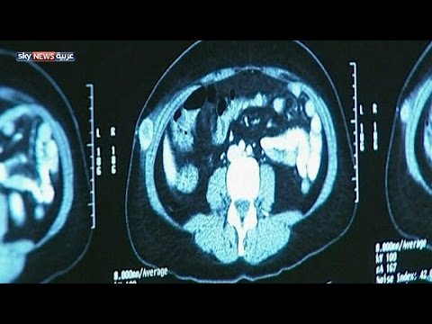 شاهد أطباء يحذرون من انتشار سرطان الميلانوما