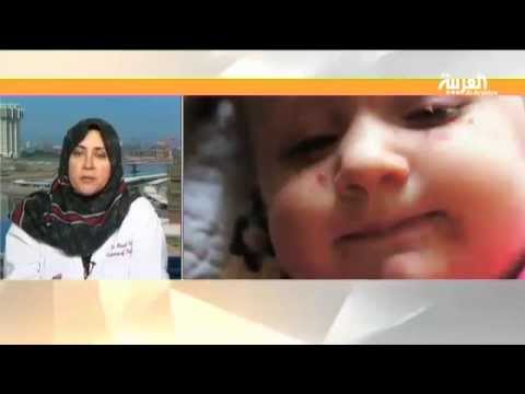 شاهد الجدري فيروس معدِ يصيب بشكل خاص الأطفال