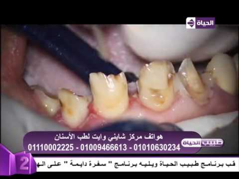 شاهد فيديو مجمع لمراحل التركيبات الثابتة للأسنان