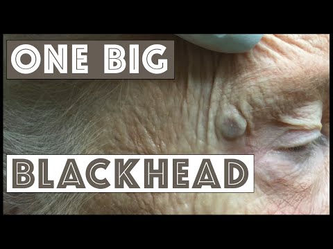 بالفيديو طبيبة تنزع رأسًا سوداء نمت بجوار عين مسنة